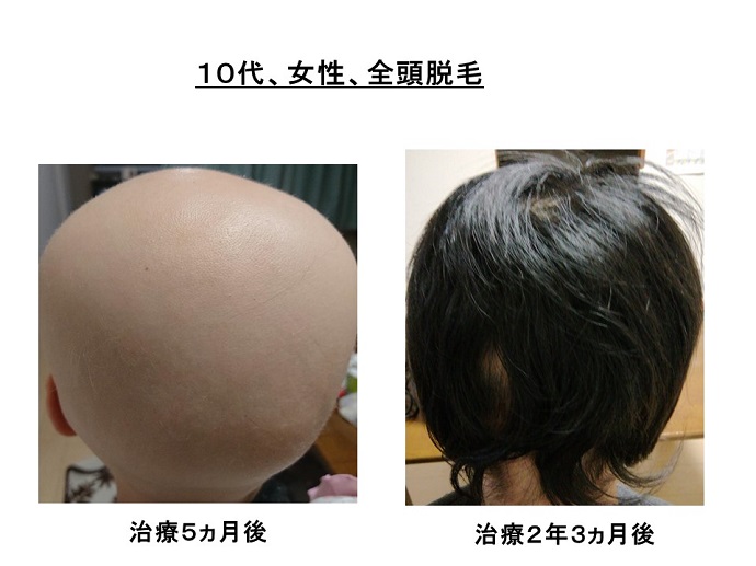 汎発性脱毛　病院